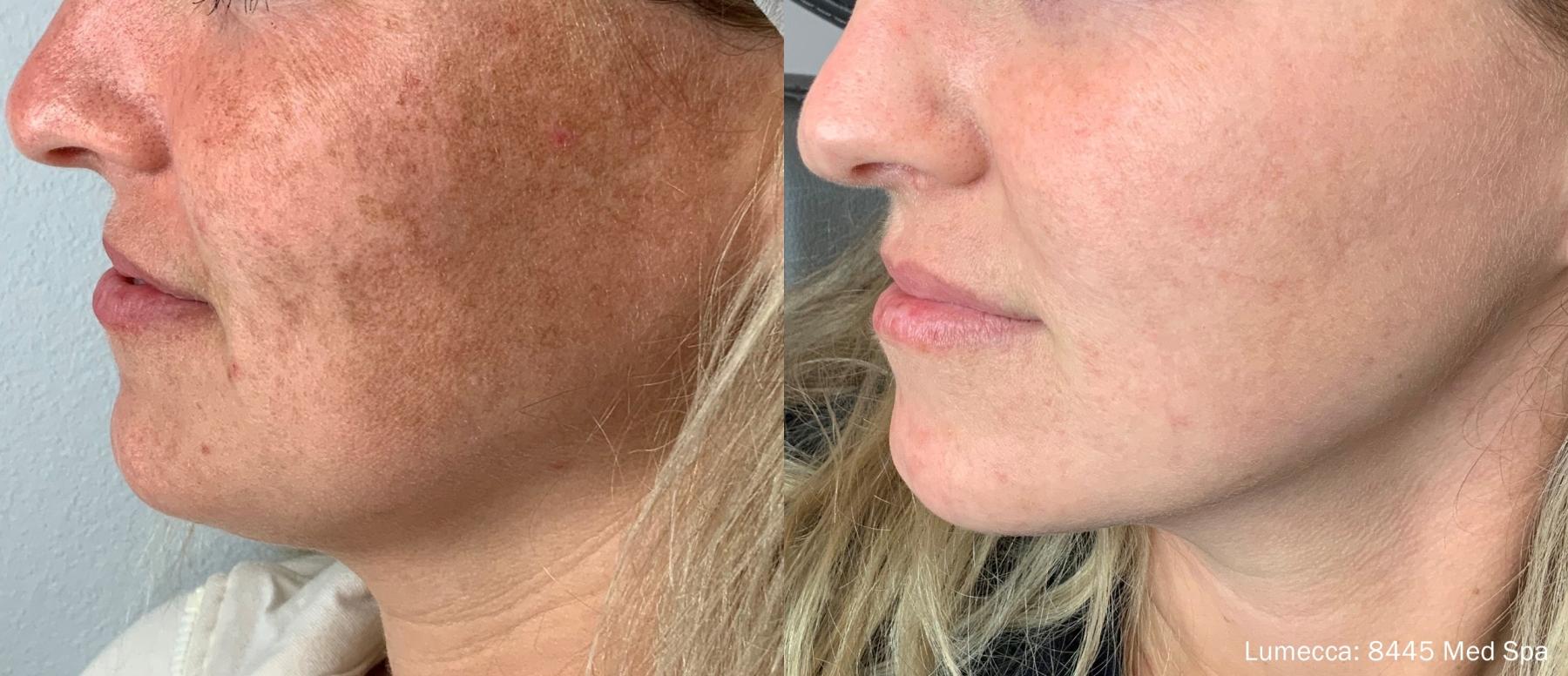 Lumecca IPL: Patient 2 - Before and After  