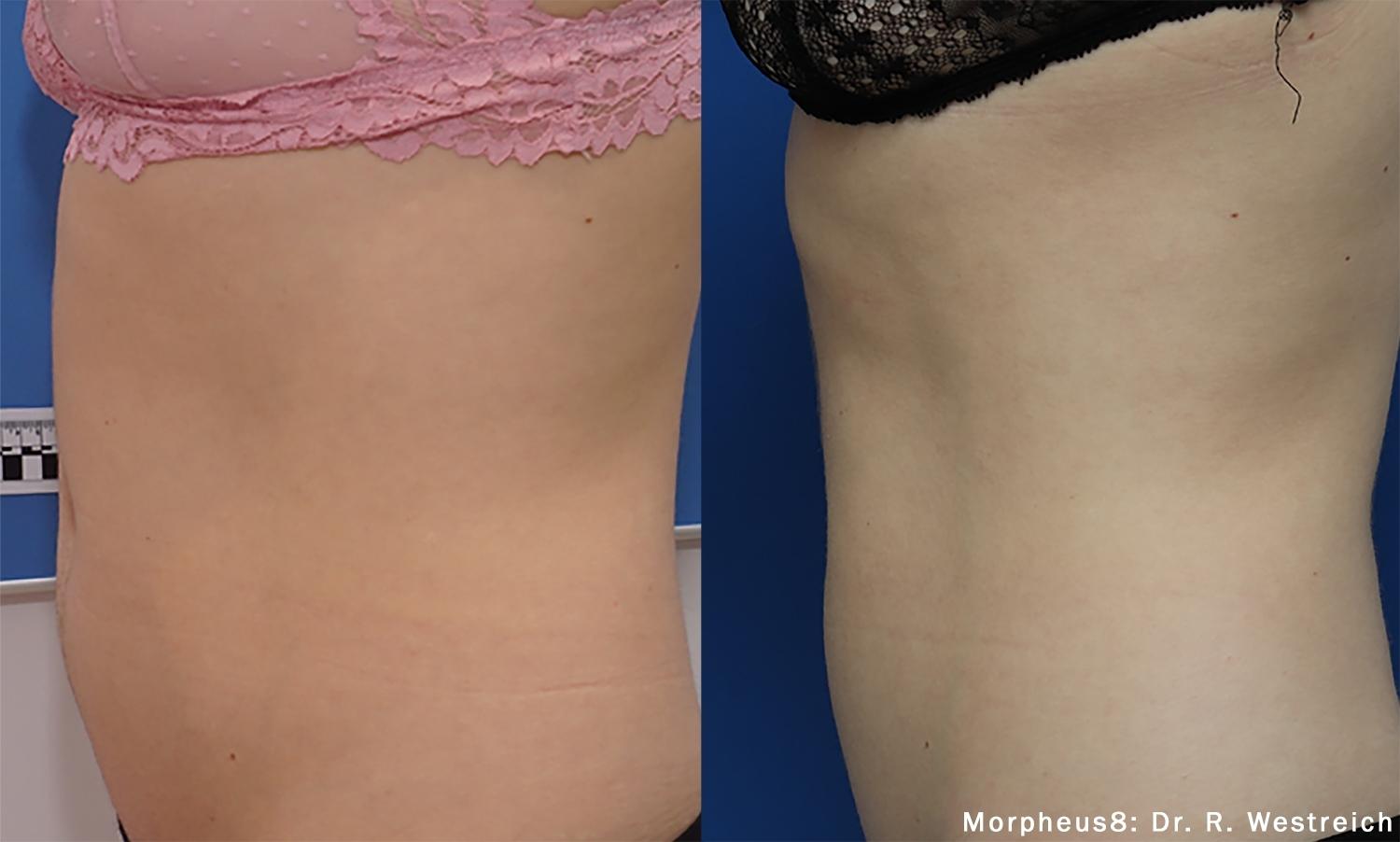 Morpheus8 Body: Patient 2 - Before and After  