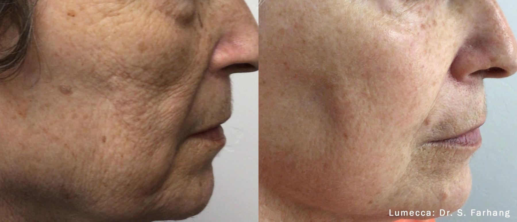 Lumecca IPL: Patient 6 - Before and After  