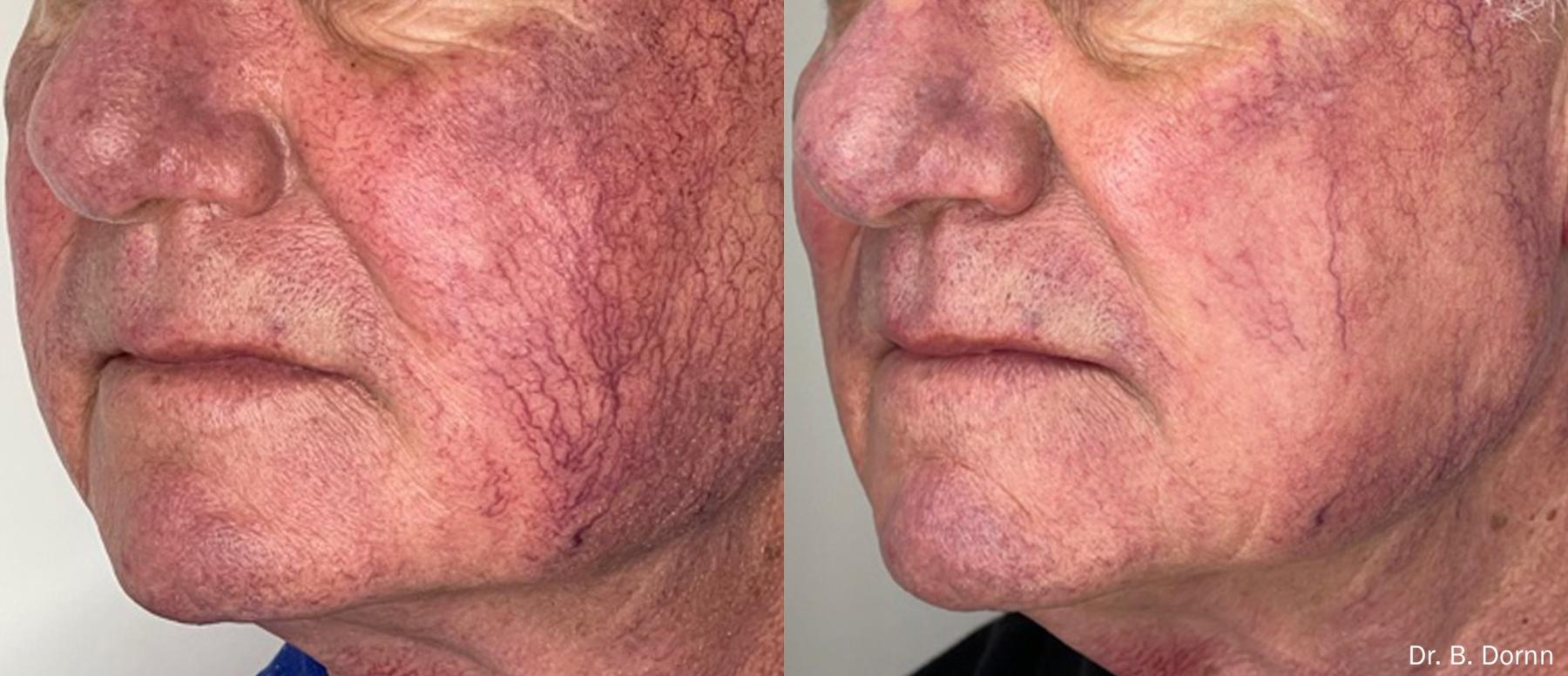 Lumecca IPL: Patient 5 - Before and After  