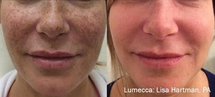 Lumecca IPL: Patient 1 - Before and After  