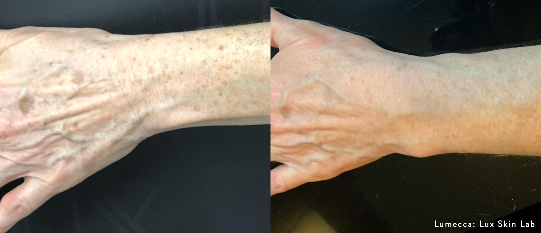 Lumecca IPL: Patient 8 - Before and After 1