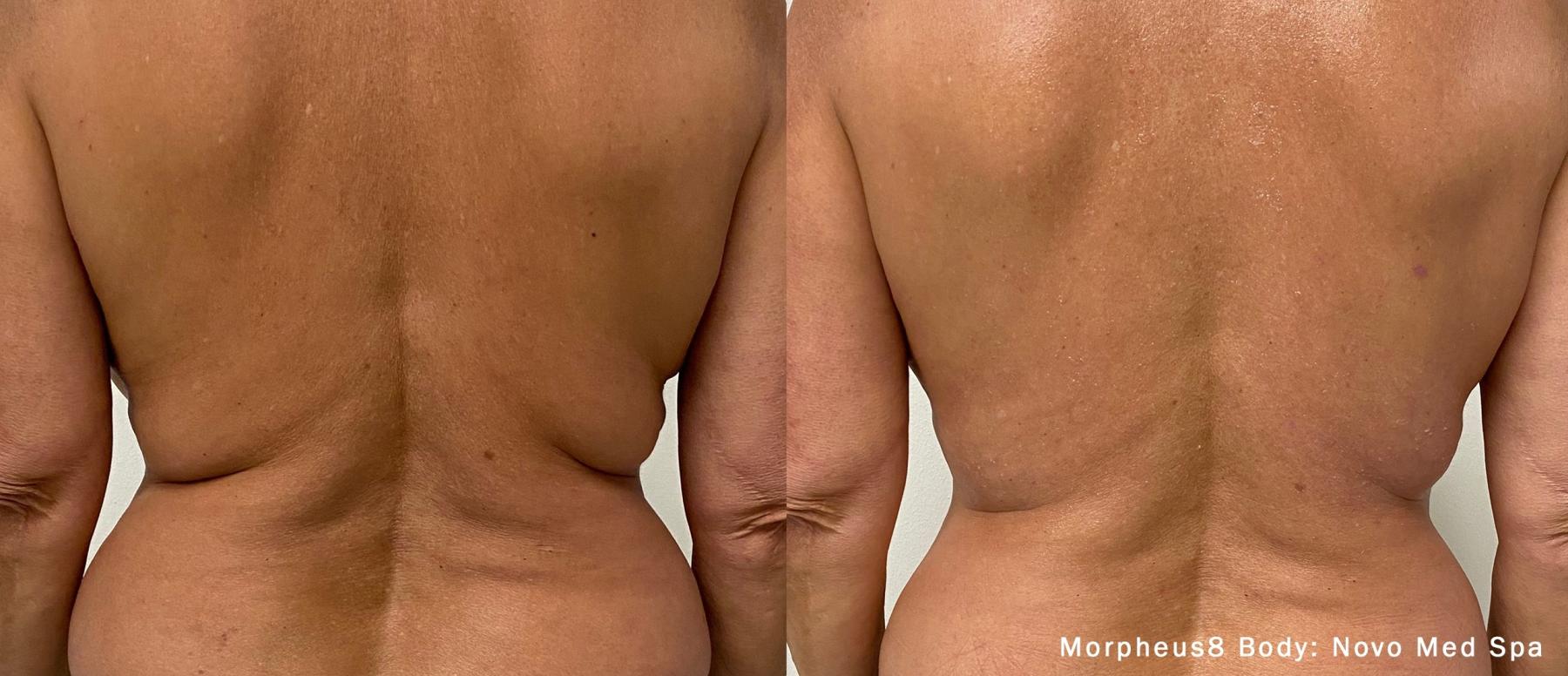 Morpheus8 Body: Patient 3 - Before and After  