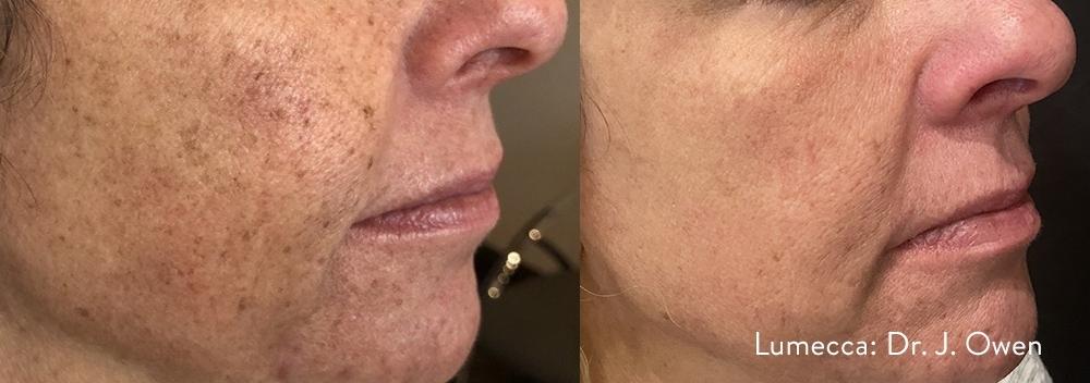 Lumecca IPL: Patient 4 - Before and After 1