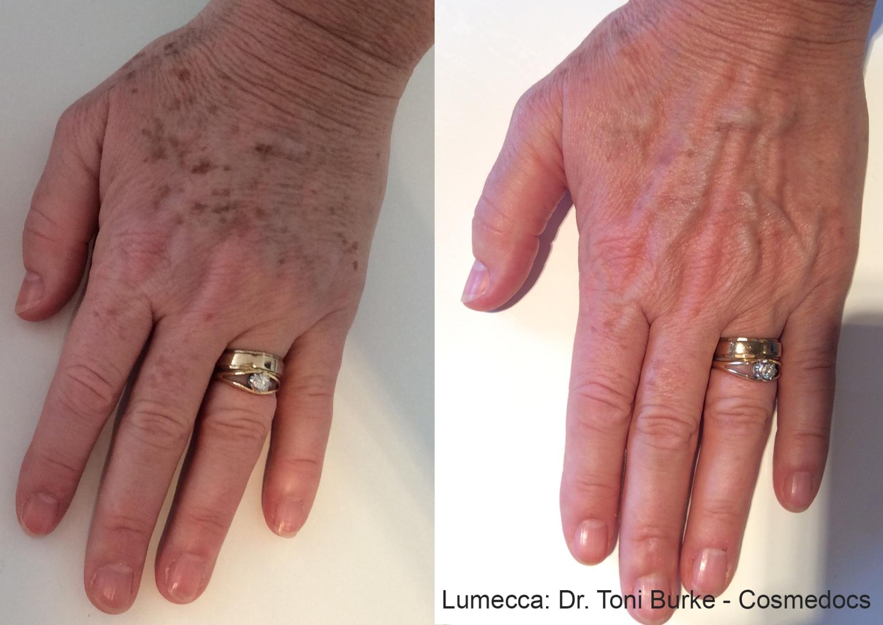 Lumecca IPL: Patient 7 - Before and After  