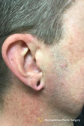 Before and after earlobe repair by Julia Spears MD - After 