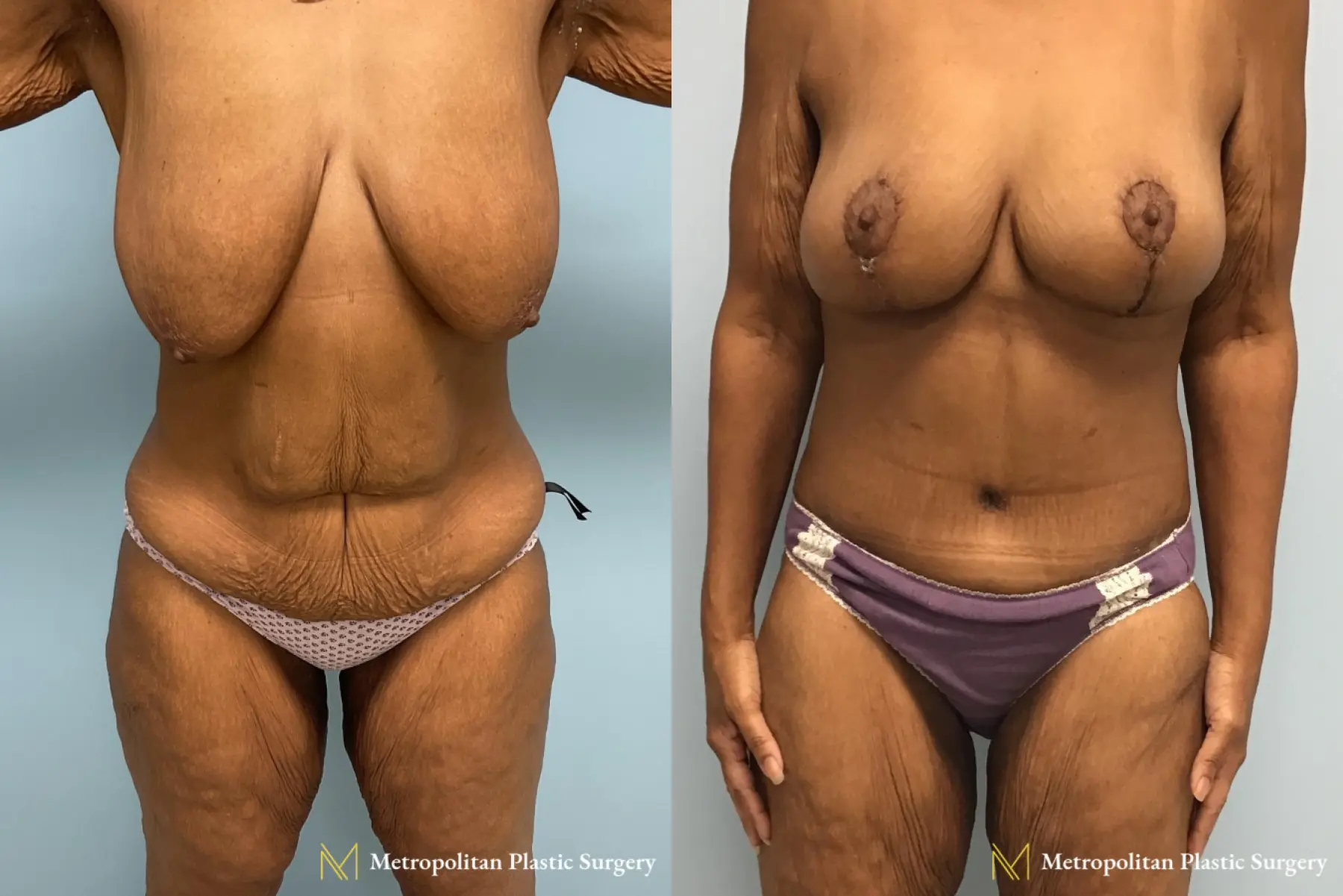 Abdominoplasty: Patient 1 - Before and After  