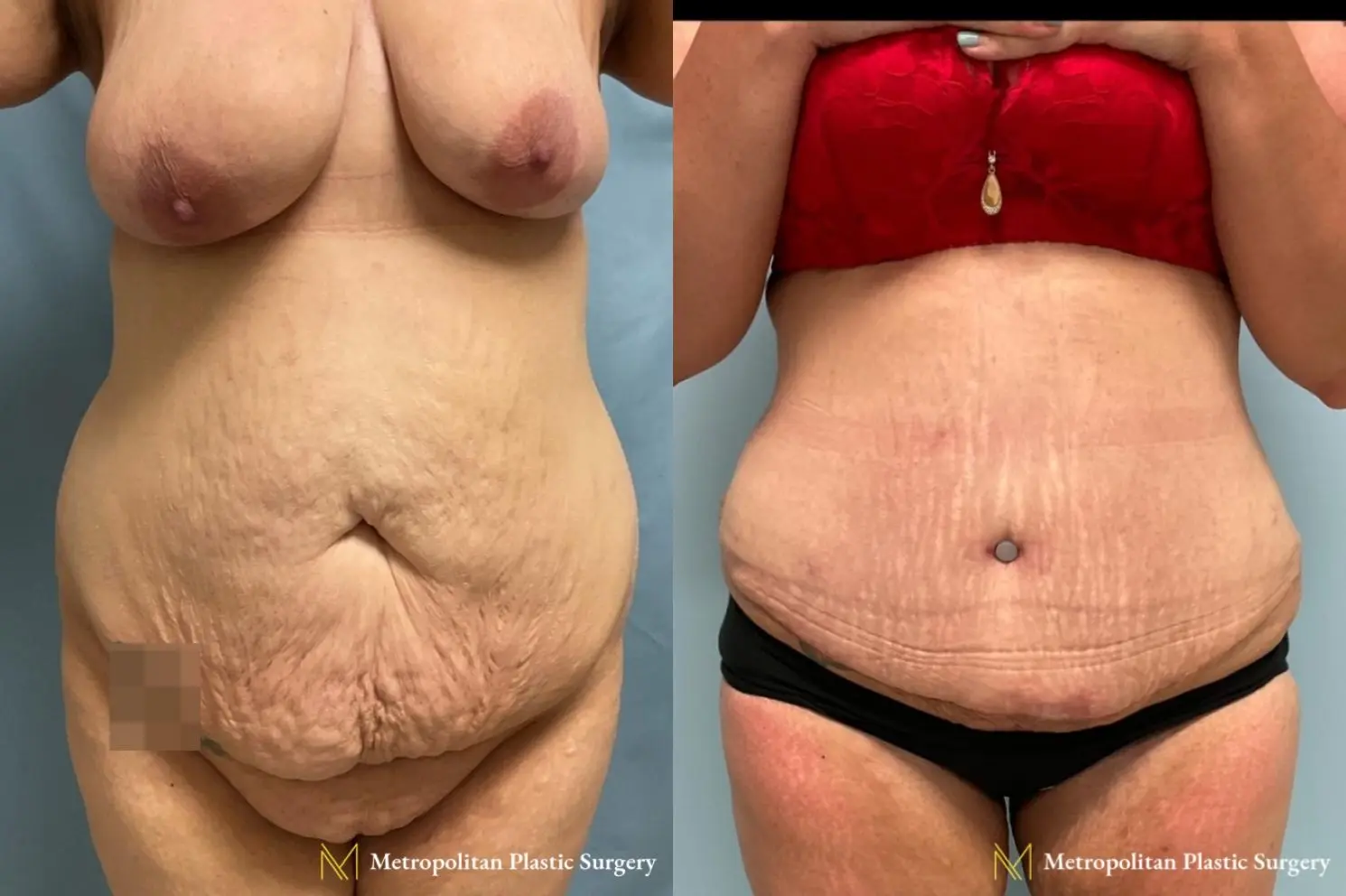 Abdominoplasty: Patient 10 - Before and After  