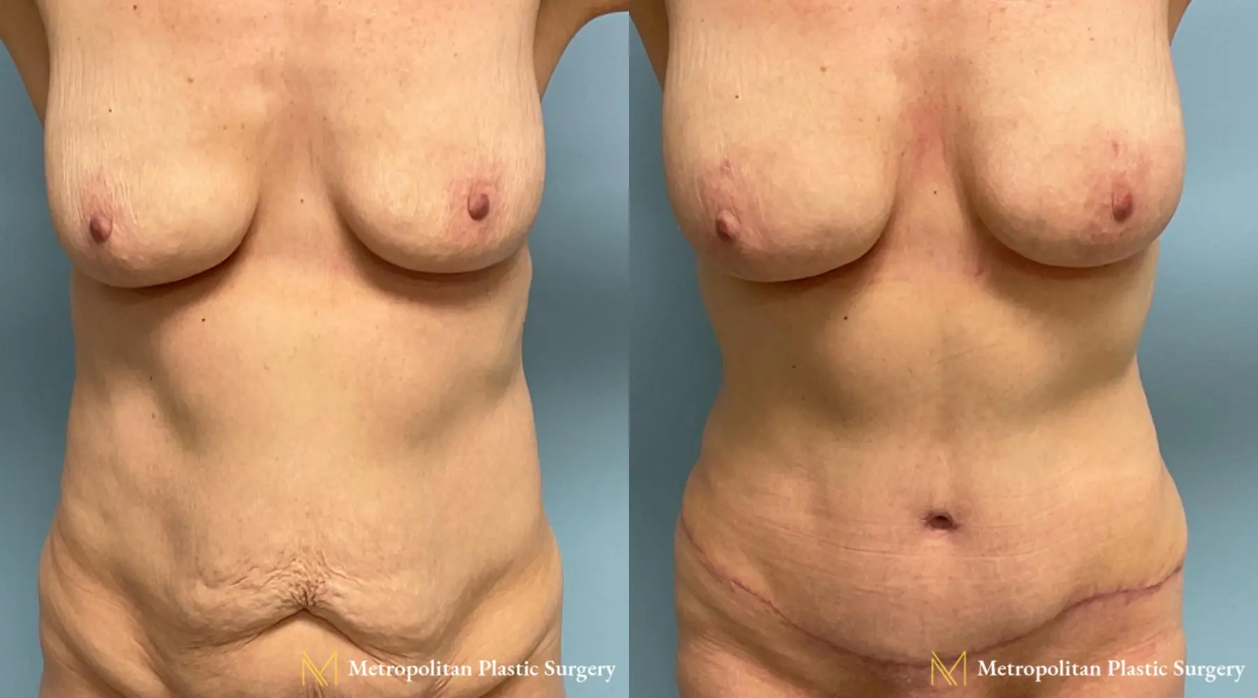 Abdominoplasty Marlton NJ - Before and After