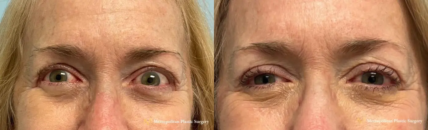 No more tired eyes with eye lid surgery from Julia Spears MD - Before and After
