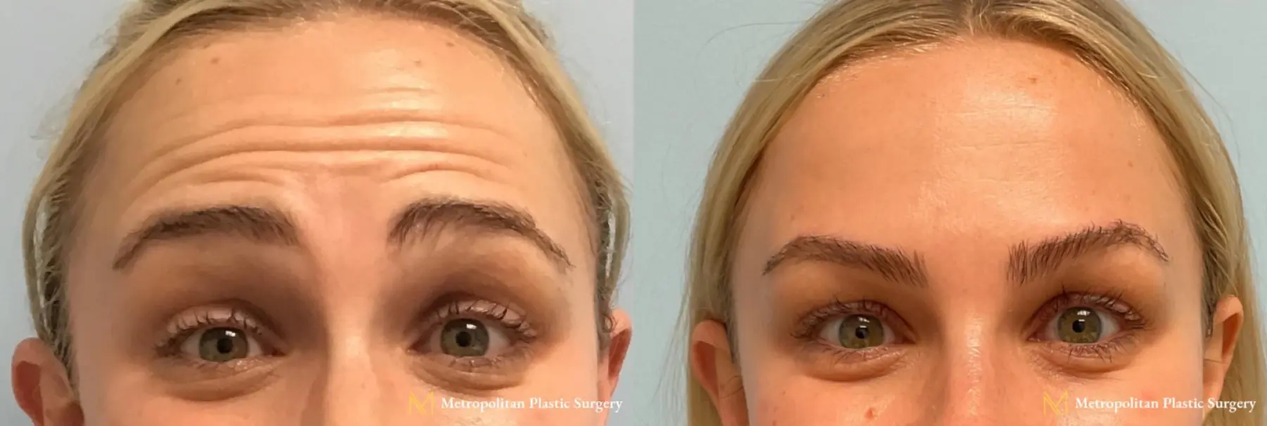 BOTOX® Cosmetic: Patient 4 - Before and After  