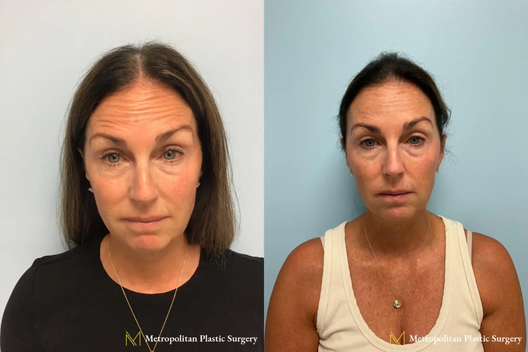 BOTOX® Cosmetic: Patient 3 - Before and After  