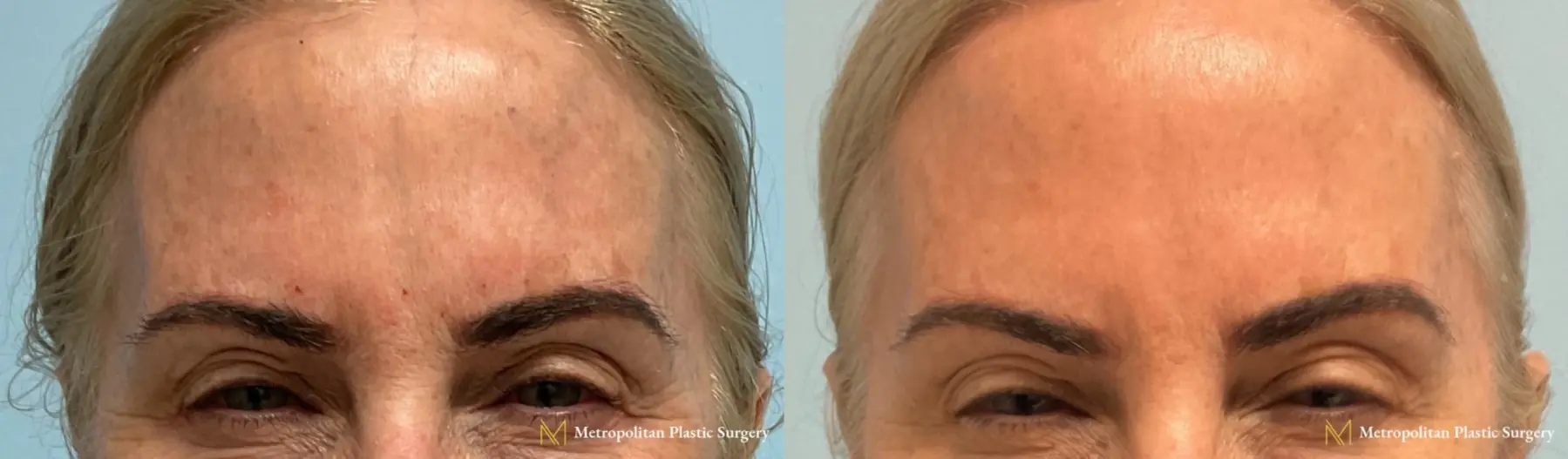 BOTOX® Cosmetic: Patient 5 - Before and After  