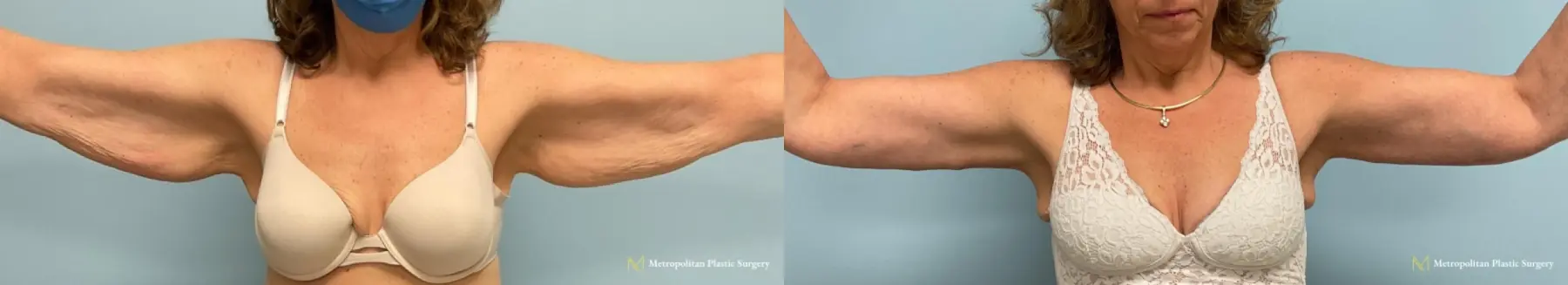 Remove Excess Arm skin and fat with Brachioplasty from Julia Spears MD - Before and After
