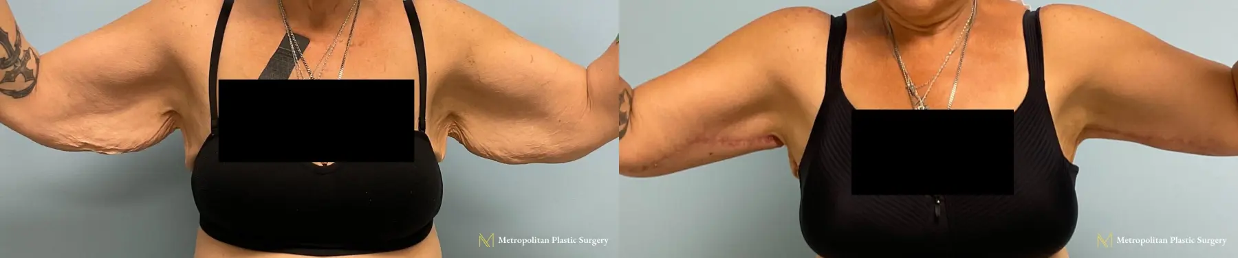 Julia Spears MD Arm Lift Surgery (Brachioplasty) Before and After - Before and After