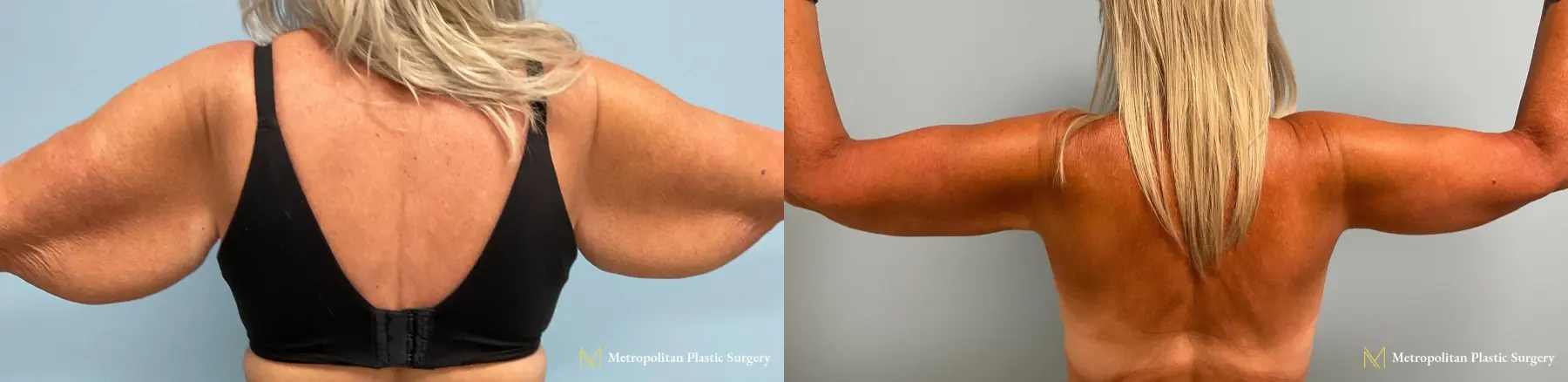 Julia Spears MD Arm Lift Surgery (Brachioplasty) Before and After - Before and After