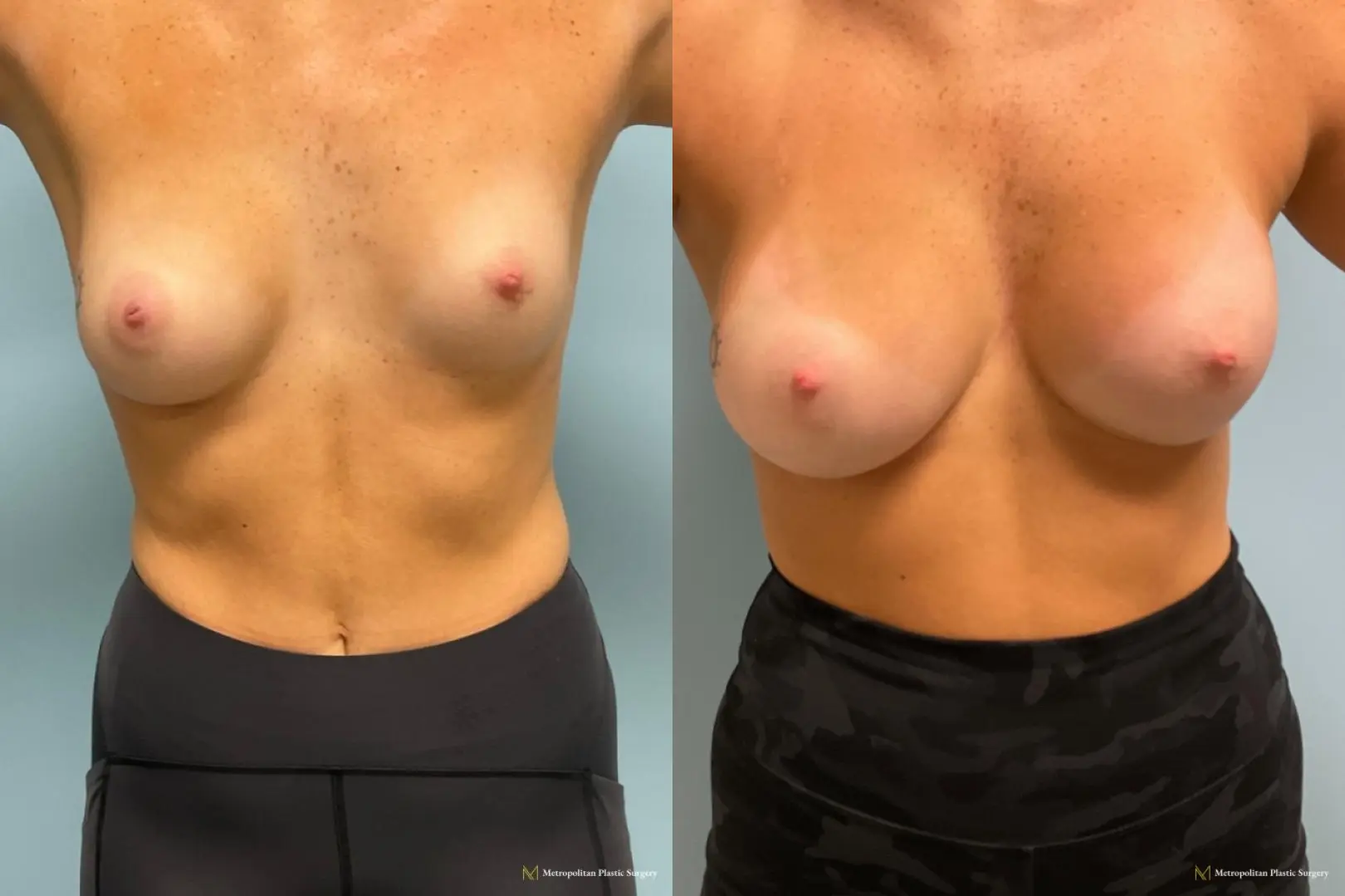 Breast Augmentation (Mammoplasty) by Julia Spears MD Before and After - Before and After