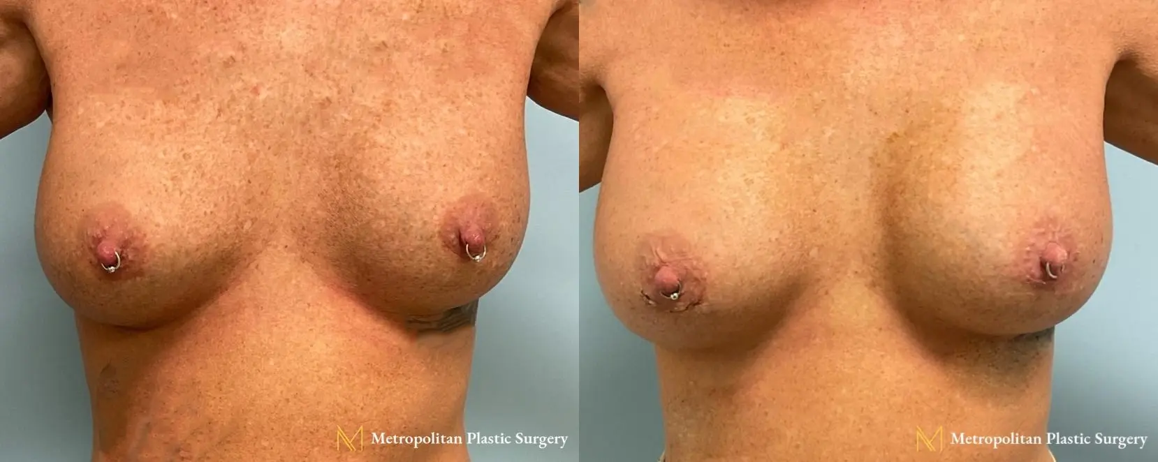 Breast Augmentation (Mammoplasty) by Julia Spears MD Before and After - Before and After