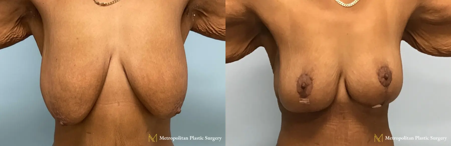 Before and after breast lift surgery by Julia Spears MD - Before and After