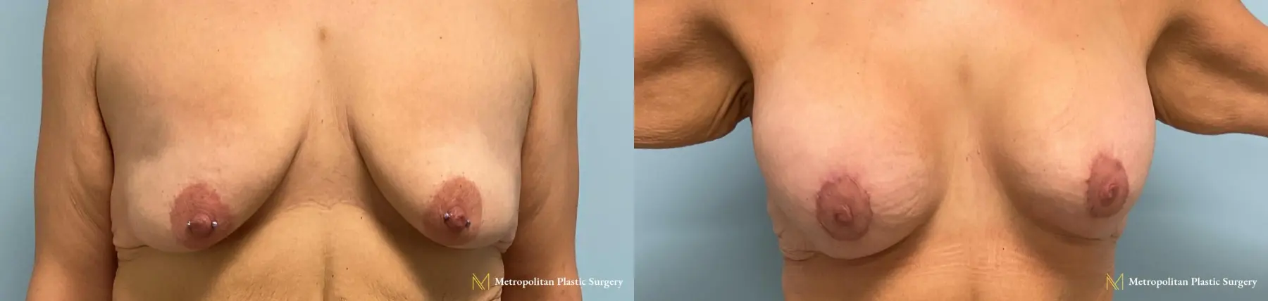 Before and after breast augmentation surgery by Julia Spears MD - Before and After