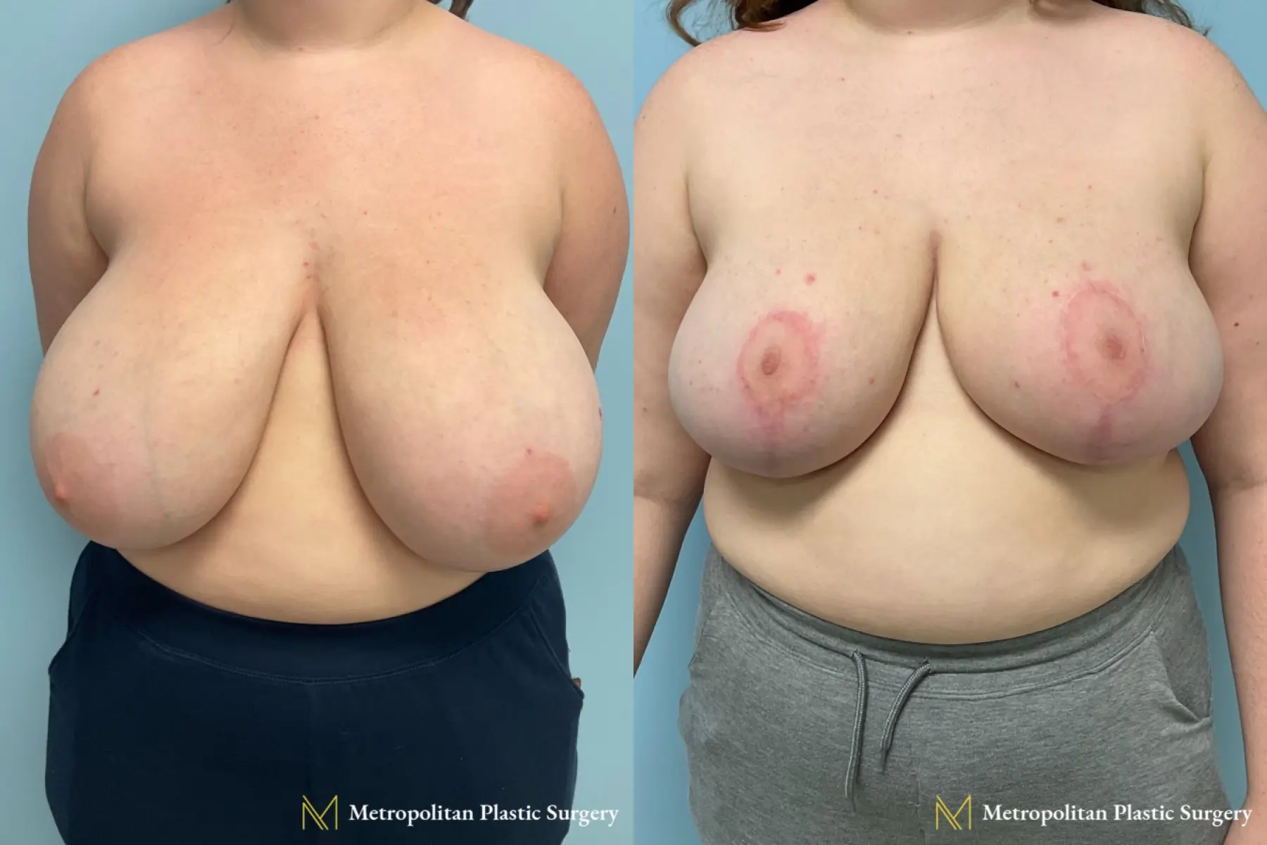 Before and after breast reduction surgery by Julia Spears MD - Before and After