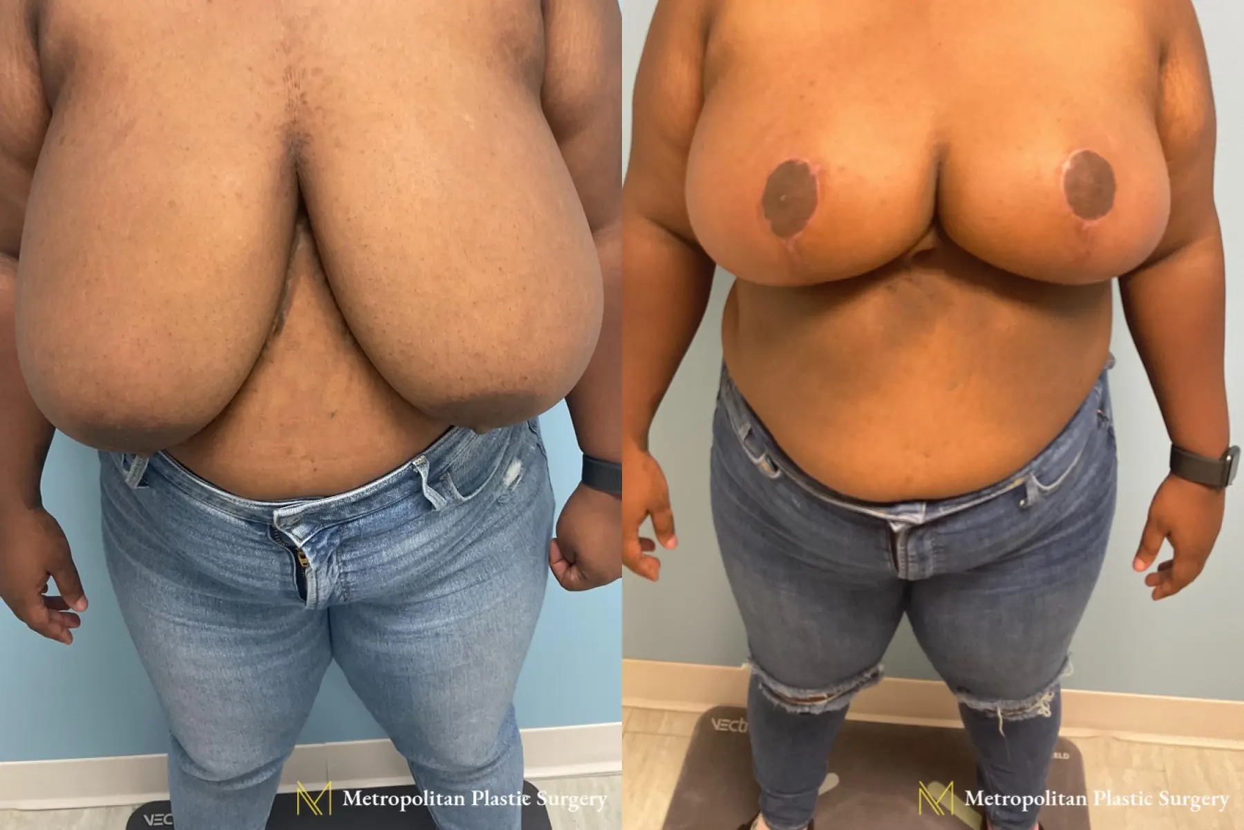 Before and after breast reduction surgery by Julia Spears MD - Before and After