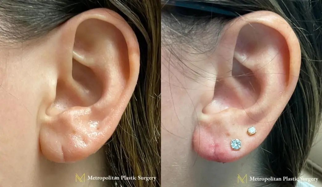 Before and after earlobe repair by Julia Spears MD - Before and After