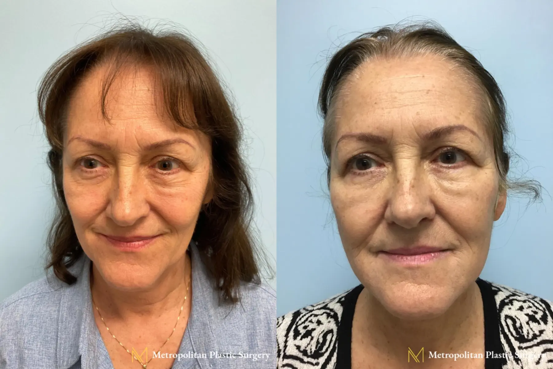Before and after face lift (rhytidectomy) neck lift from Julia Spears MD - Before and After