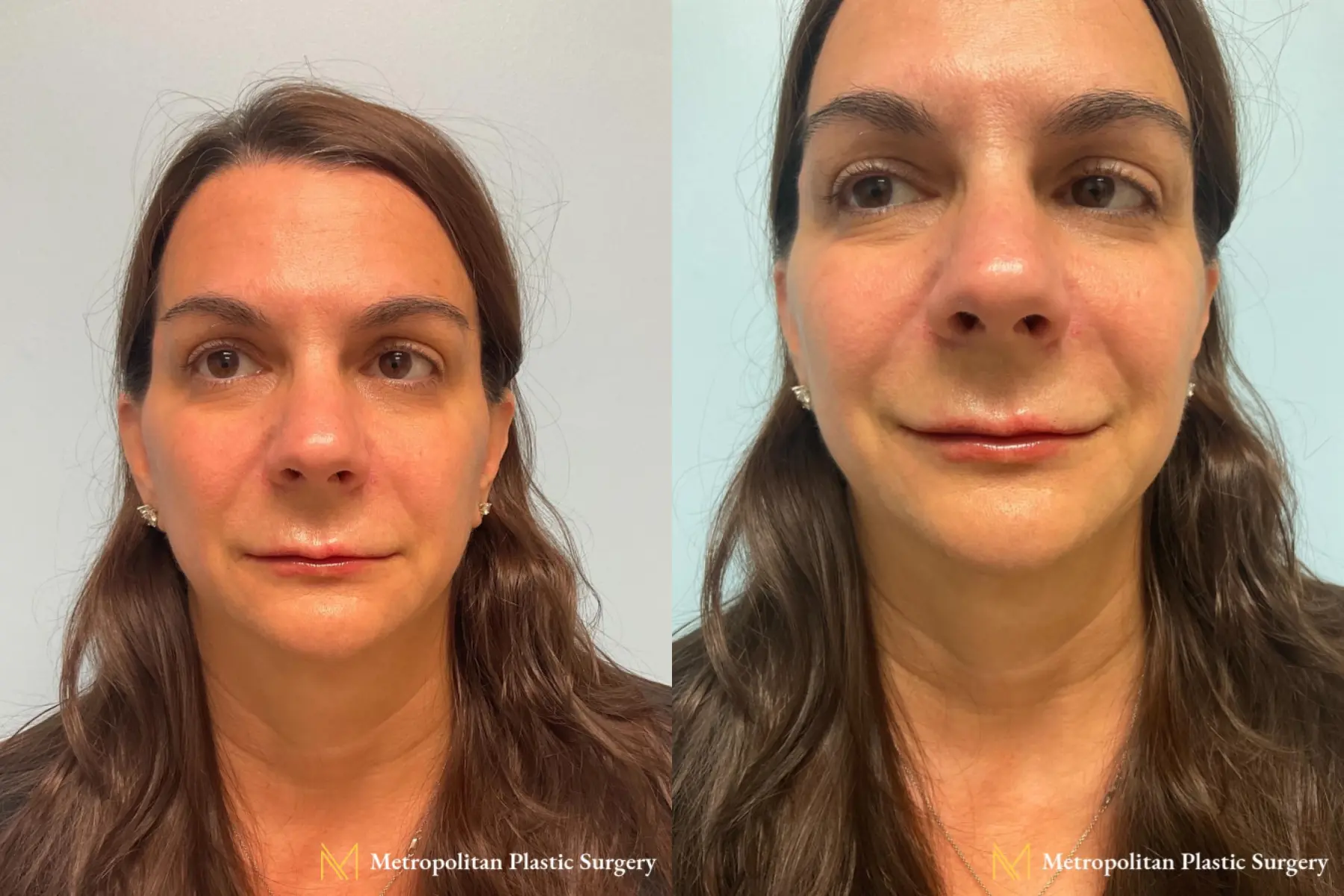 Radiesse Volumizing Filler to Take Lines and Wrinkles Away - Before and After