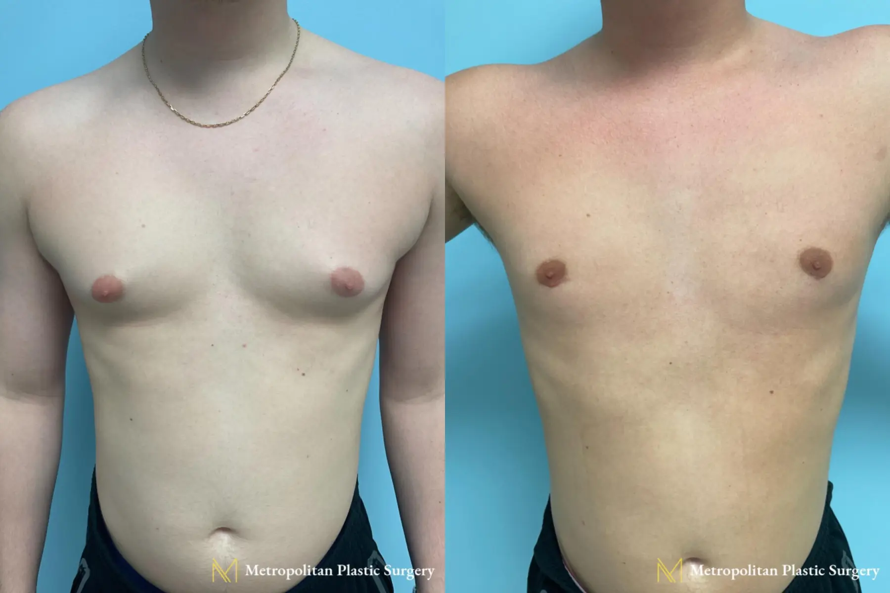 Reduce Male Breast Size with Gynecomastia by board certified Julia Spears MD, Metropolitan Plastic Surgery - Before and After