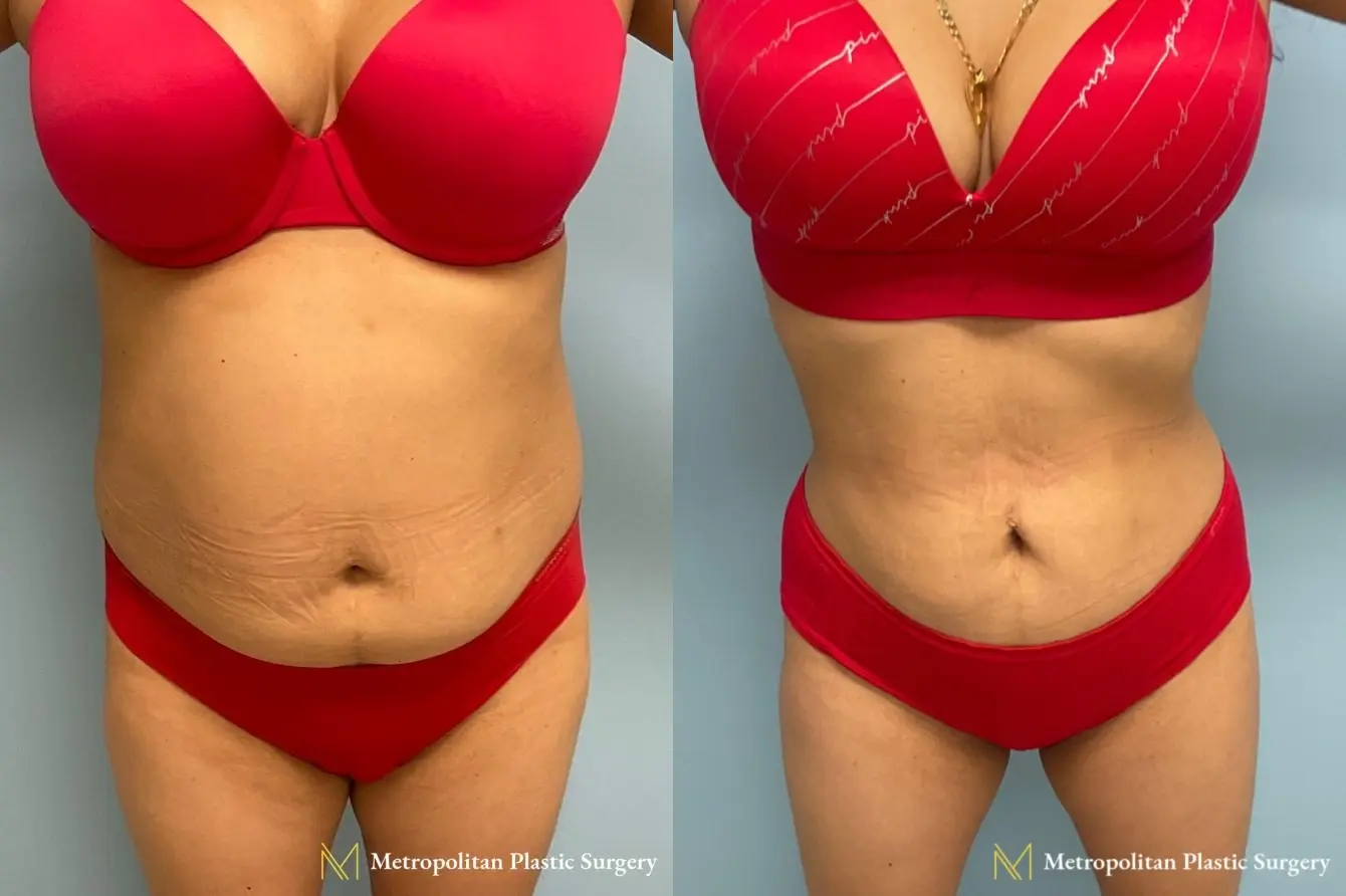 Liposuction Marlton NJ - Before and After