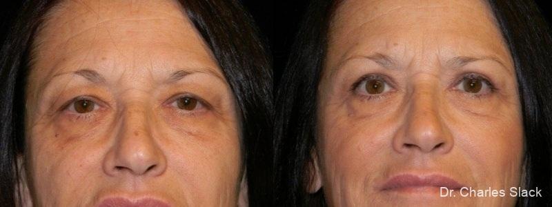 Blepharoplasty: Patient 3 - Before and After  