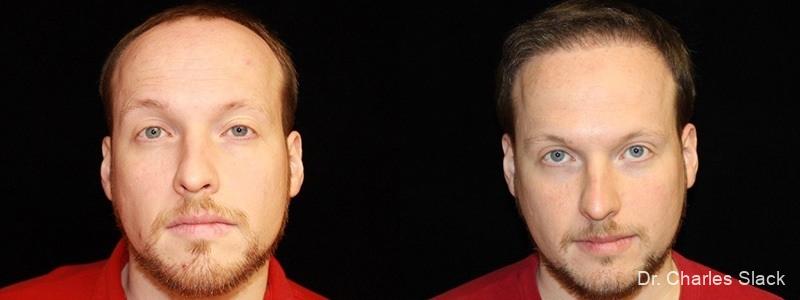 Hair Transplantation: Patient 1 - Before and After  