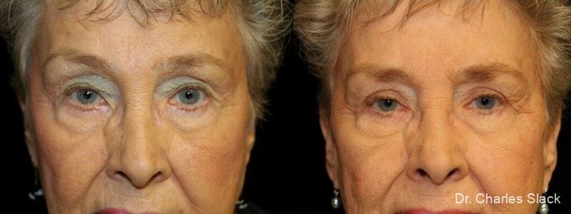Blepharoplasty: Patient 5 - Before and After  