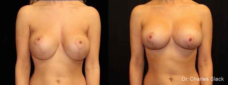 Breast Revision: Patient 9 - Before and After  