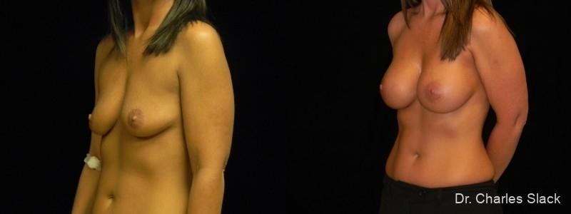 Breast Augmentation: Patient 29 - Before and After 2