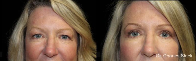 Blepharoplasty: Patient 7 - Before and After  