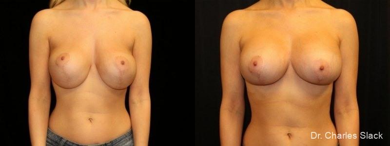 Breast Revision: Patient 5 - Before and After  