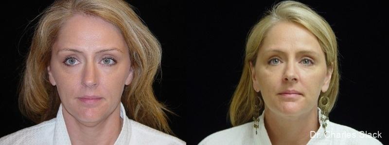 Liposuction Of The Neck: Patient 1 - Before and After  