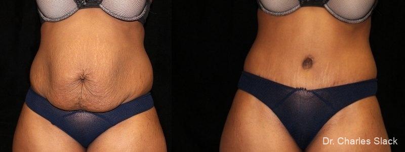 Tummy Tuck: Patient 22 - Before and After 