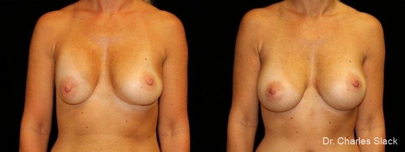 Breast Revision: Patient 2 - Before and After  