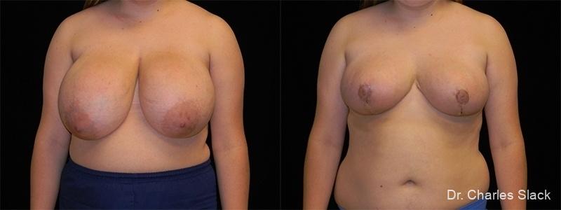 Breast Reduction: Patient 4 - Before and After  