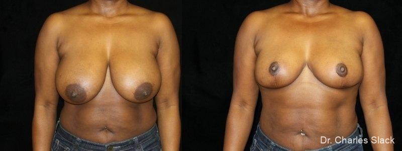 Breast Reduction: Patient 1 - Before and After  