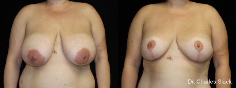Breast Reduction: Patient 10 - Before and After  