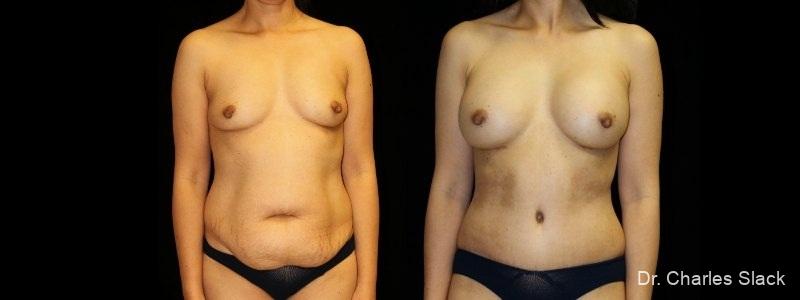 Mommy Makeover: Patient 9 - Before and After  