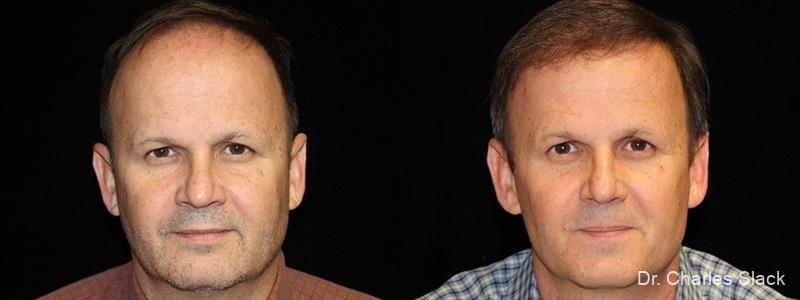 Hair Transplantation: Patient 2 - Before and After  