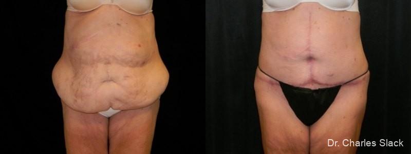 After Weight Loss: Patient 2 - Before and After  