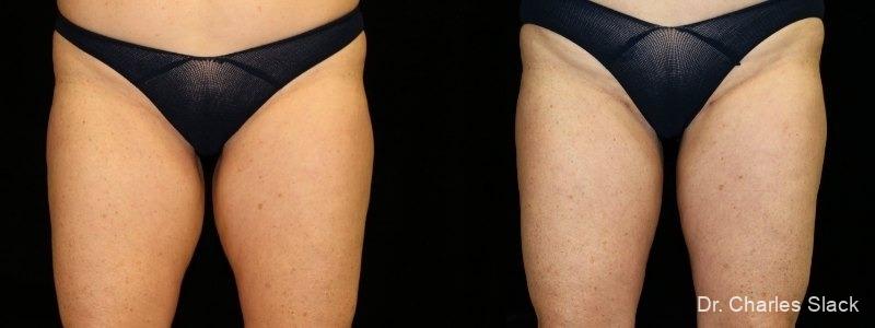 Liposuction: Patient 3 - Before and After  