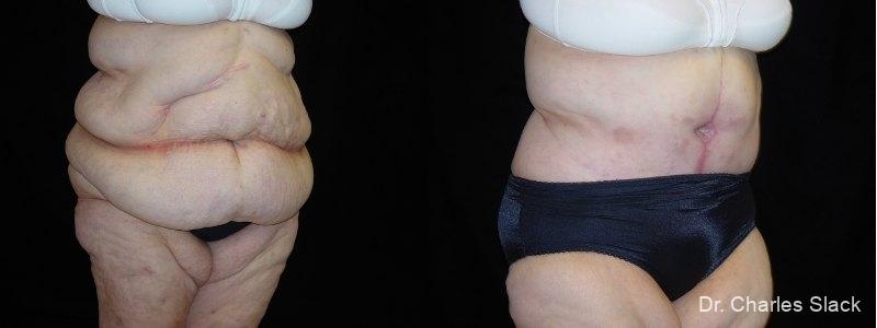 After Weight Loss: Patient 1 - Before and After  