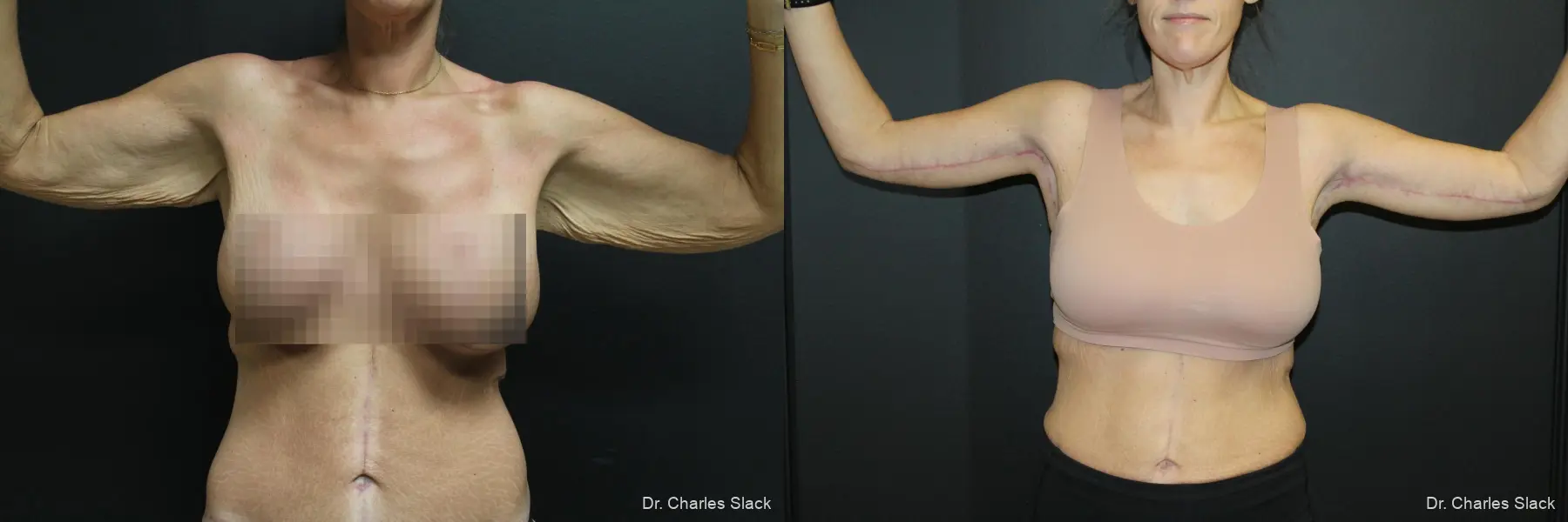 Arm Lift: Patient 1 - Before and After  